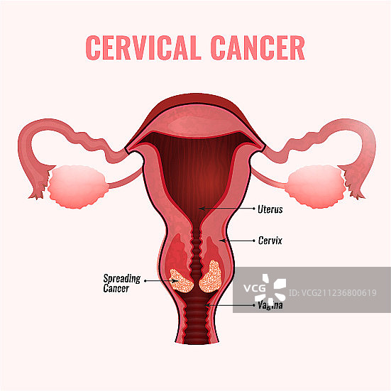 宫颈癌图像图片素材