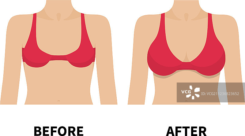 女性隆胸整形前后对比图片素材