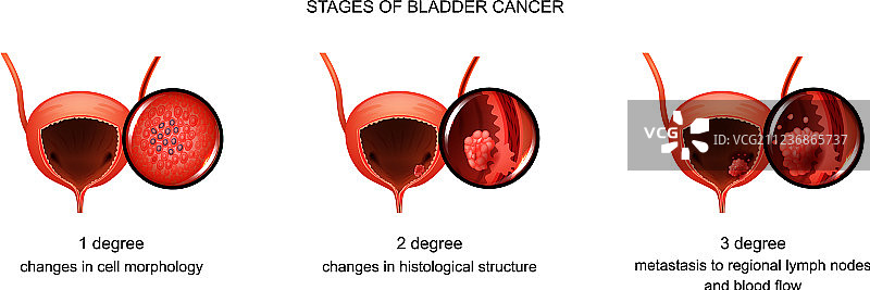 膀胱癌分期图片素材