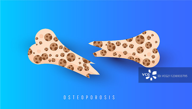 骨质疏松症骨骼与健康骨骼图片素材