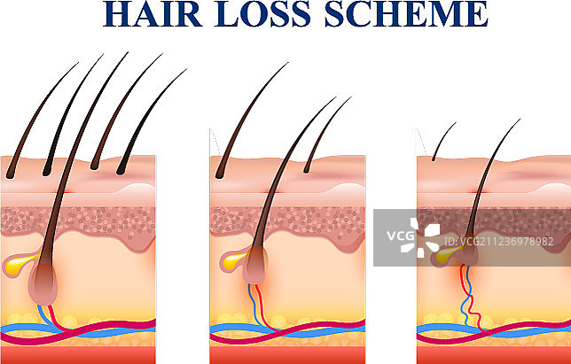 脱发示意图图片素材