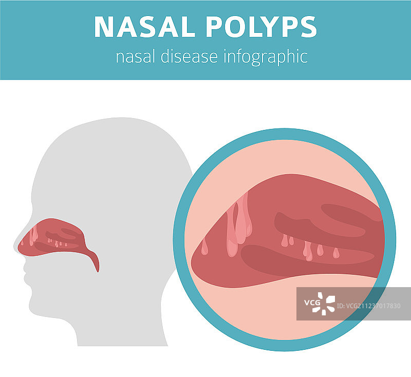鼻腔疾病鼻息肉病因诊断图片素材