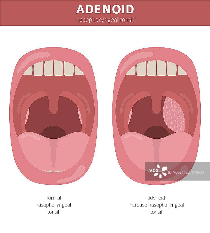 鼻咽疾病腺样体图片素材
