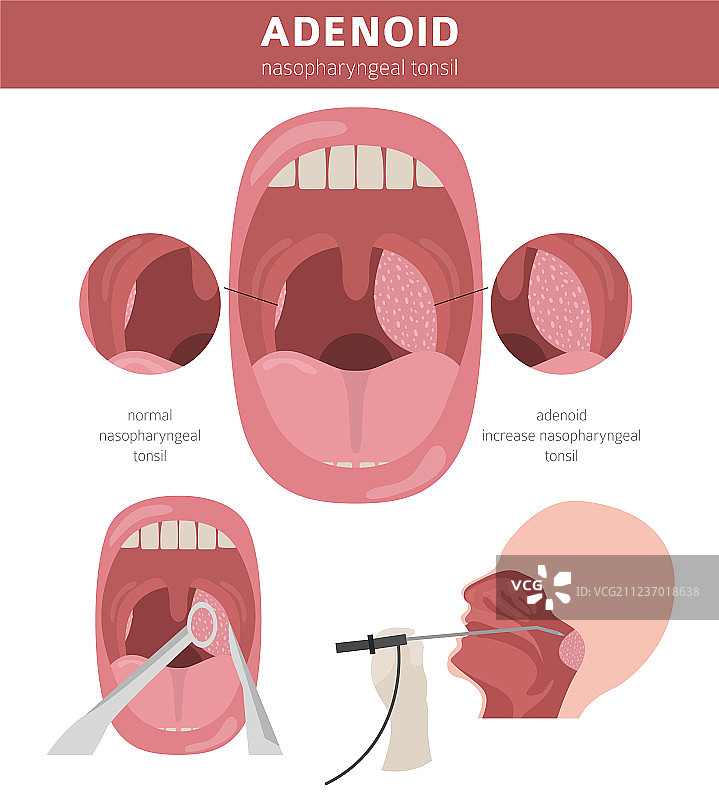 鼻咽疾病腺样体图片素材