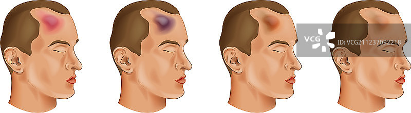 额头上的瘀伤图片素材