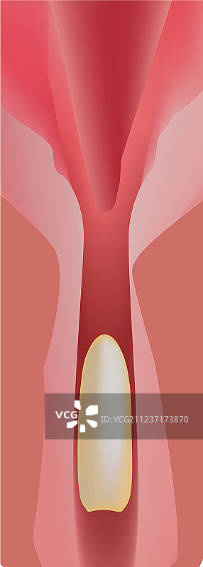 避孕栓剂信息图图片素材