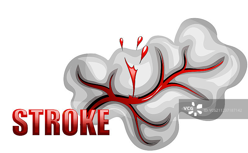 血管破裂引起的出血性中风图片素材