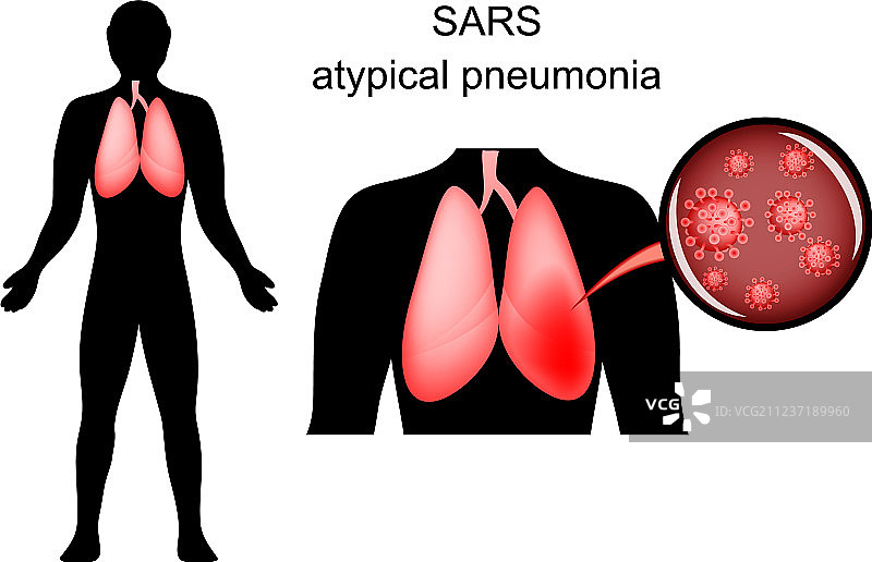 SARS感染的肺部及致病因素图片素材