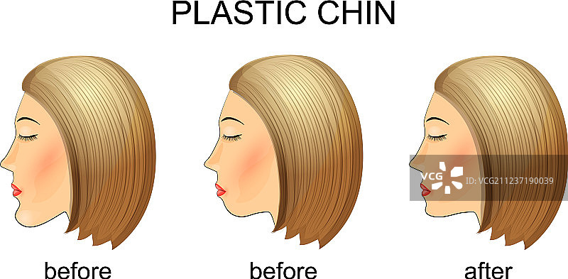 下巴整形手术前后对比图片素材