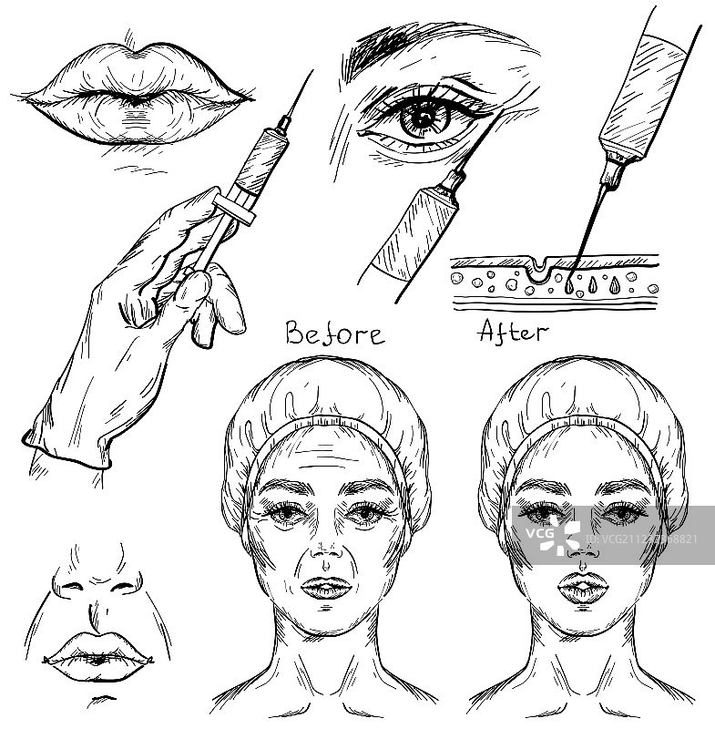 肉毒杆菌注射美容程序示意图图片素材