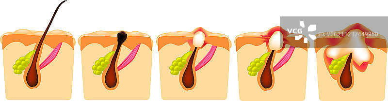 痤疮类型：开口粉刺和闭口粉刺图片素材