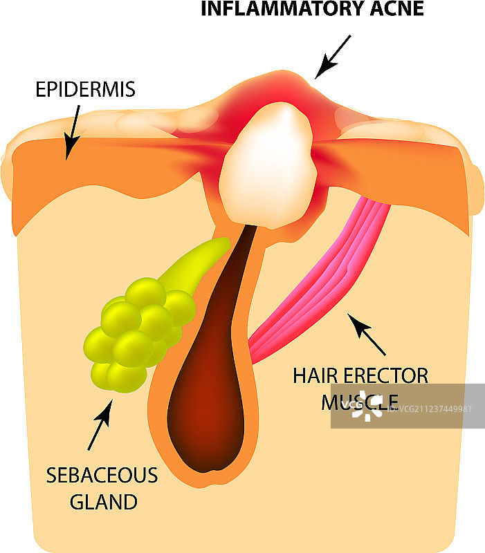 炎性粉刺痤疮图片素材
