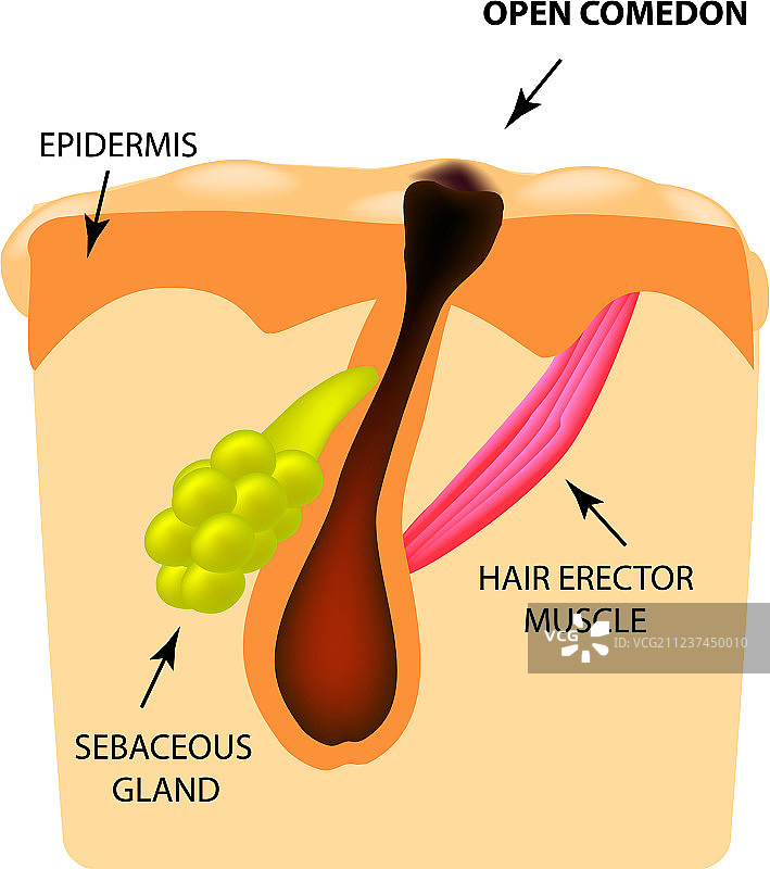 开放性粉刺黑头痤疮皮肤结构图片素材
