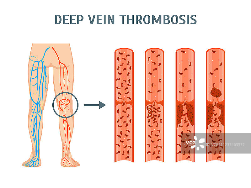 卡通深静脉血栓形成信息图卡片图片素材