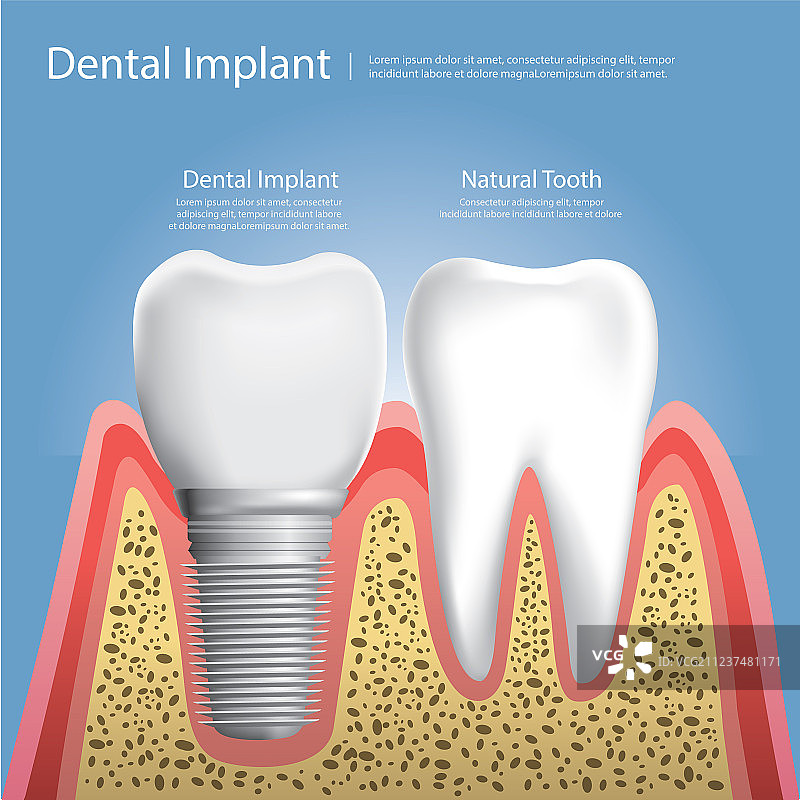 人的牙齿和牙科植入物图片素材
