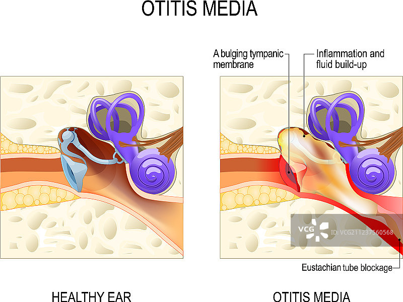中耳炎图片素材