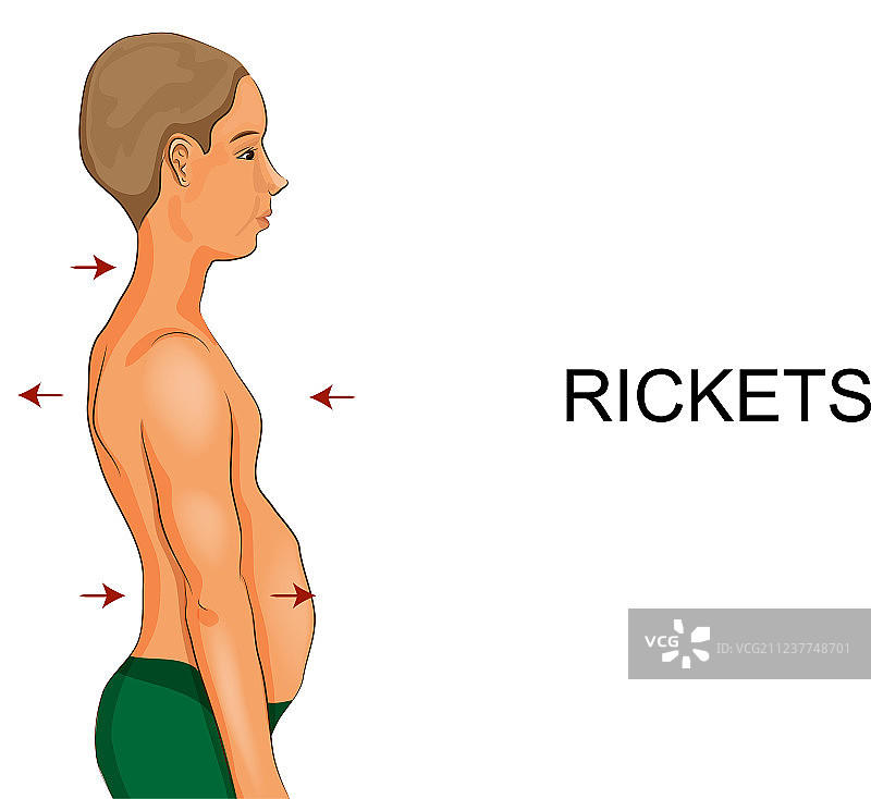 患有佝偻病的男孩图片素材