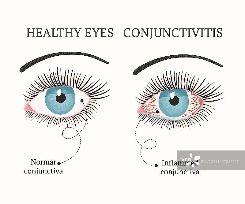 眼科疾病健康图片素材