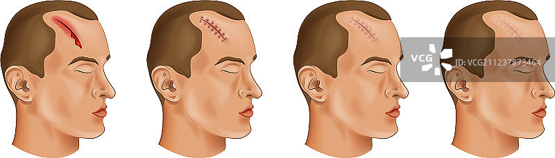 头部伤口图片素材