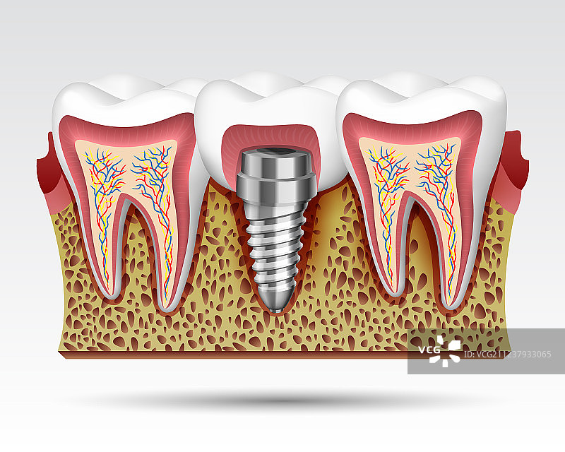 带有神经末梢的3D牙齿切面图片素材