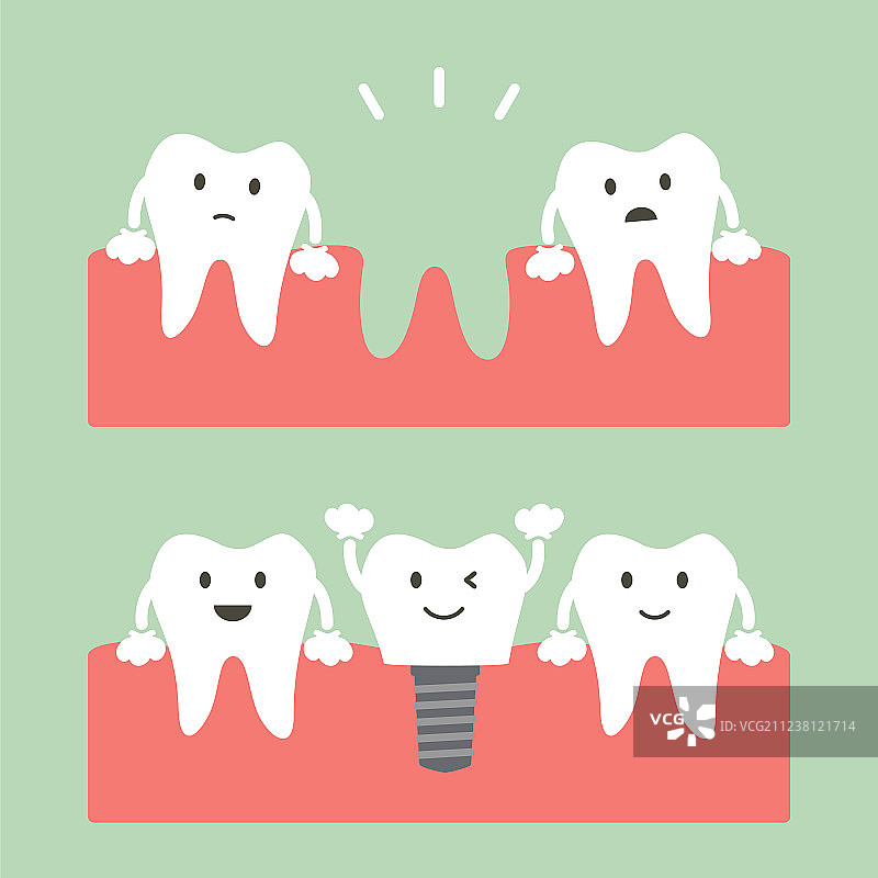 牙科种植体填充图片素材