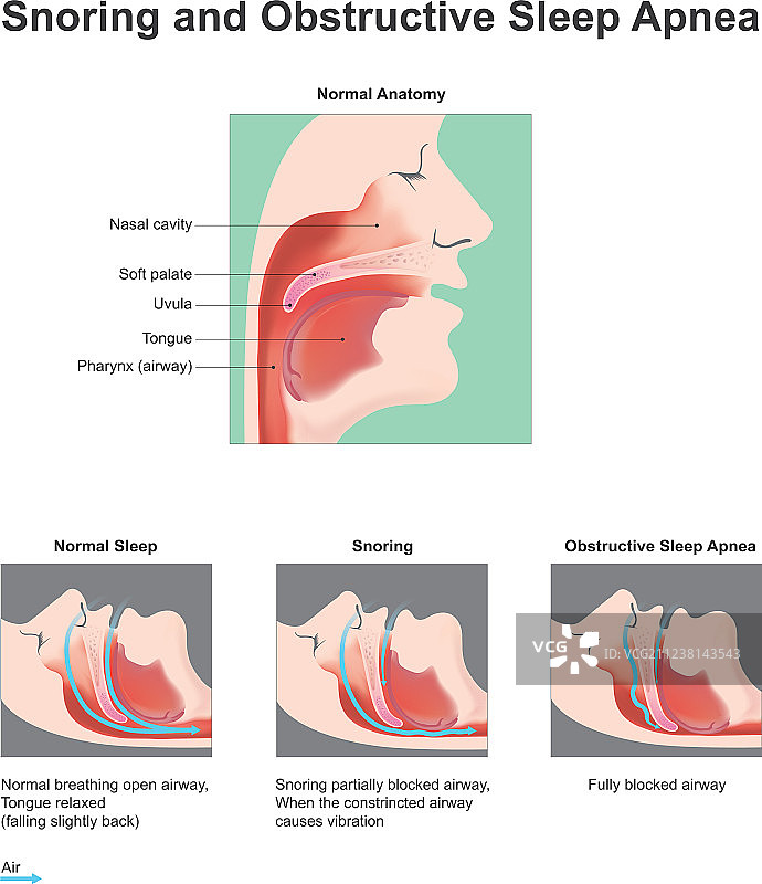打鼾和阻塞性睡眠呼吸暂停图片素材