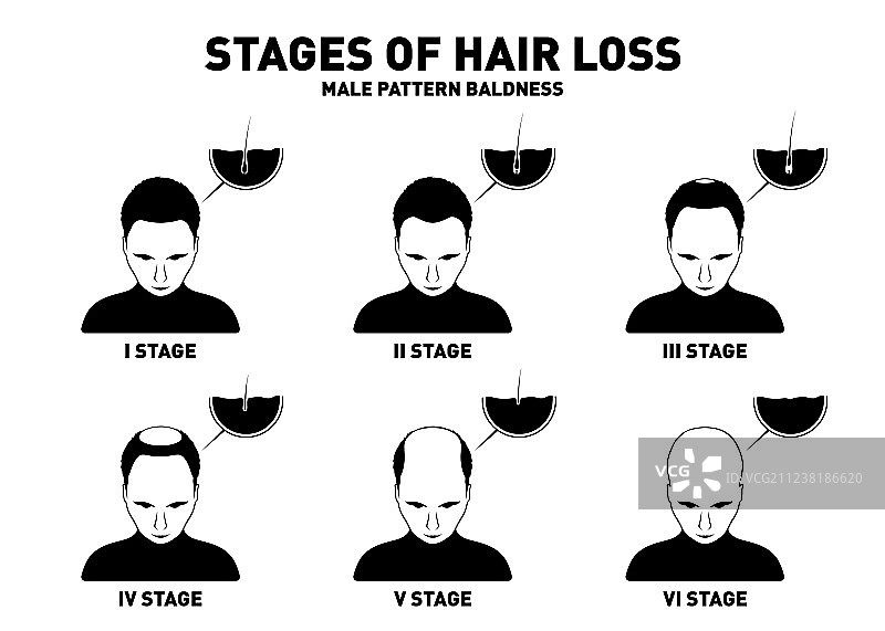 男性脱发阶段和类型图片素材