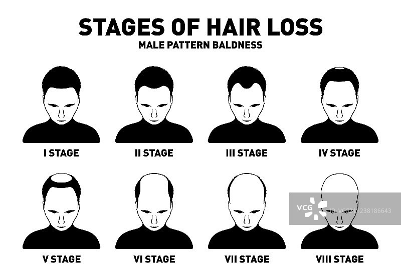 男性脱发阶段和类型图片素材