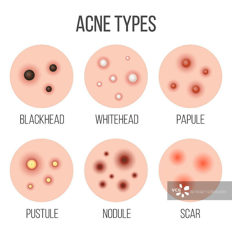 创意痤疮类型图片素材