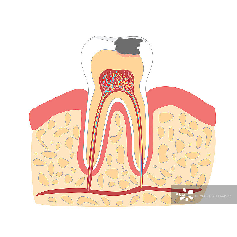带龋齿阶段的卡通牙齿图片素材