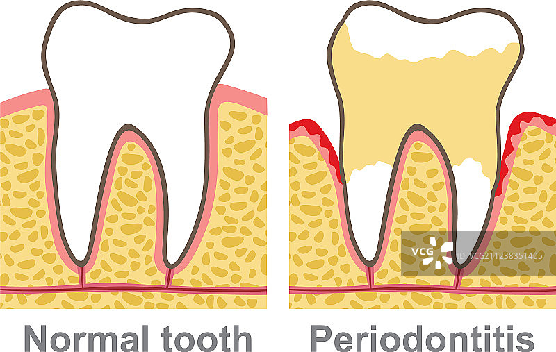牙龈出血牙周病口腔护理图片素材