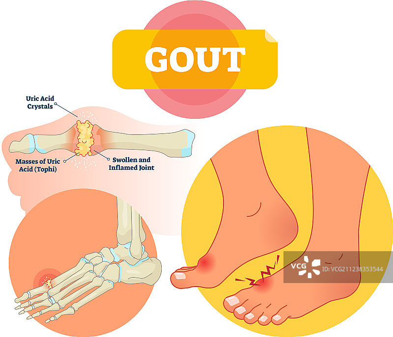 痛风医学标签方案图片素材