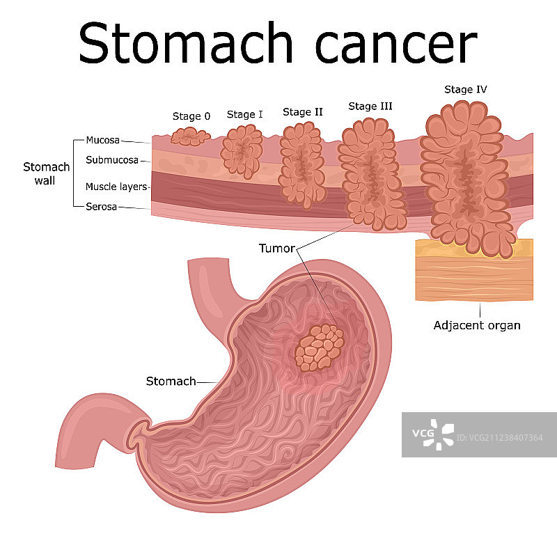 胃癌图片素材