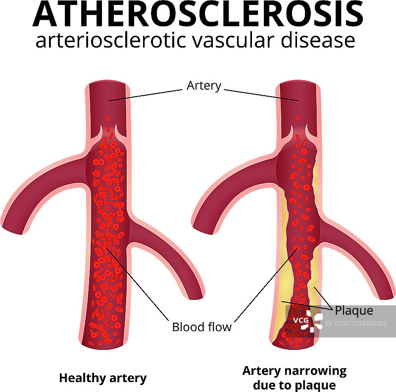 冠状动脉疾病图片素材