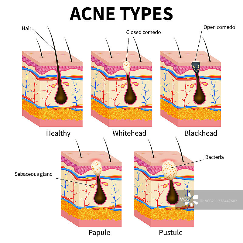 痤疮类型粉刺皮肤疾病解剖医学图片素材