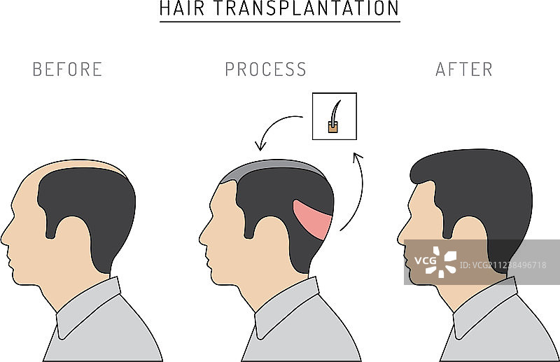 毛发移植图片素材