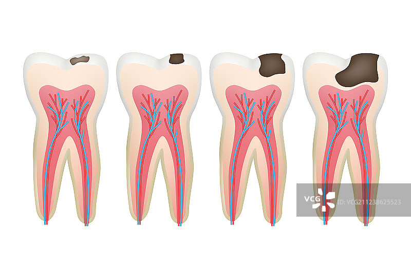 龋齿蛀牙牙髓牙科问题图片素材