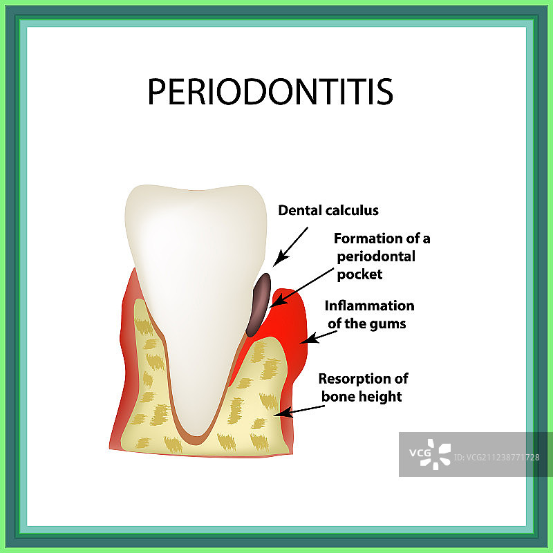 牙周炎牙科疾病炎症图片素材
