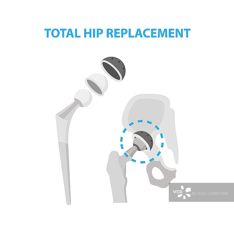 髋关节骨关节炎图片素材