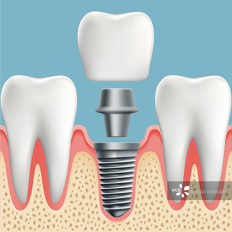 人的牙齿和牙科植入物图片素材