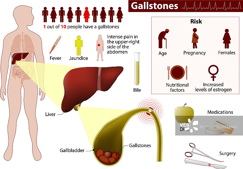 胆结石图片素材