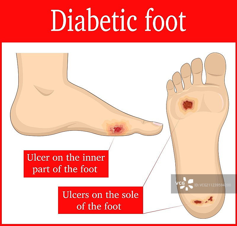糖尿病足图片素材