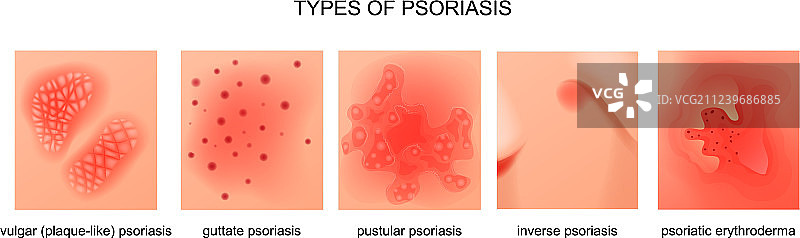 银屑病类型图片素材
