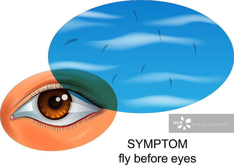 眼疾引起的眼前黑影图片素材