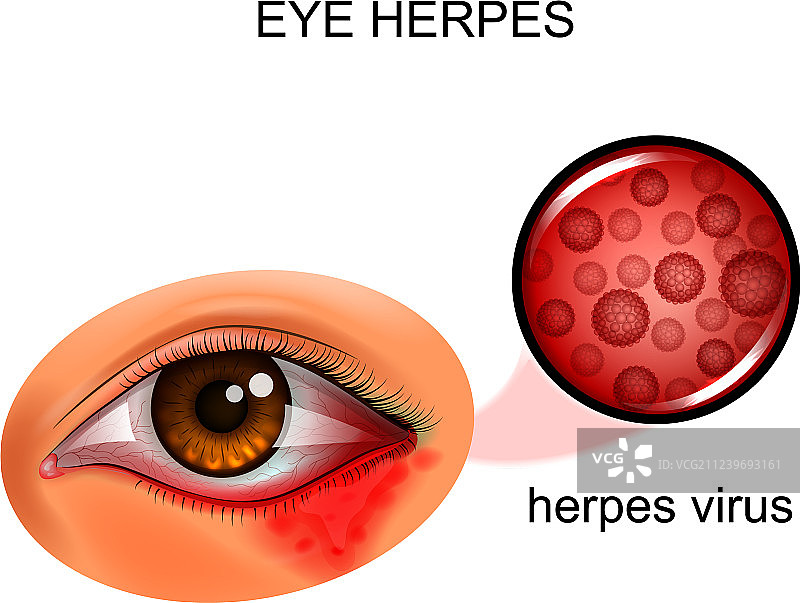 眼部疱疹病毒图片素材