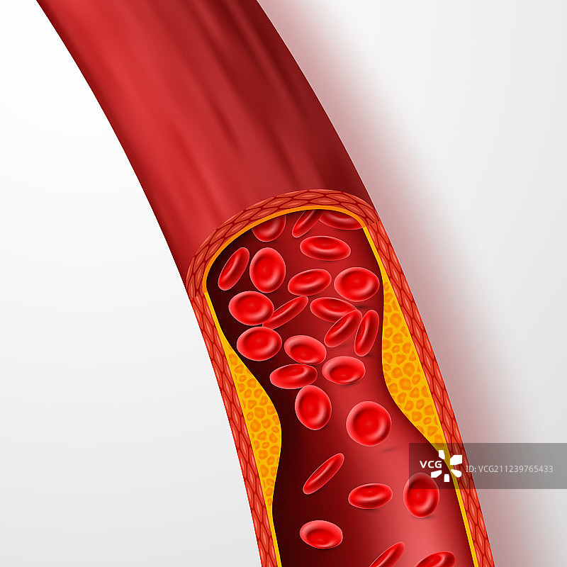 胆固醇阻塞血管动脉图片素材