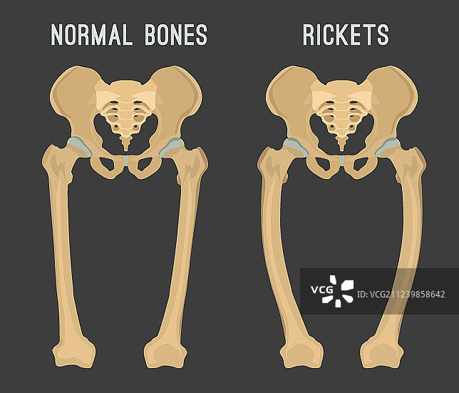 佝偻病方案图片素材