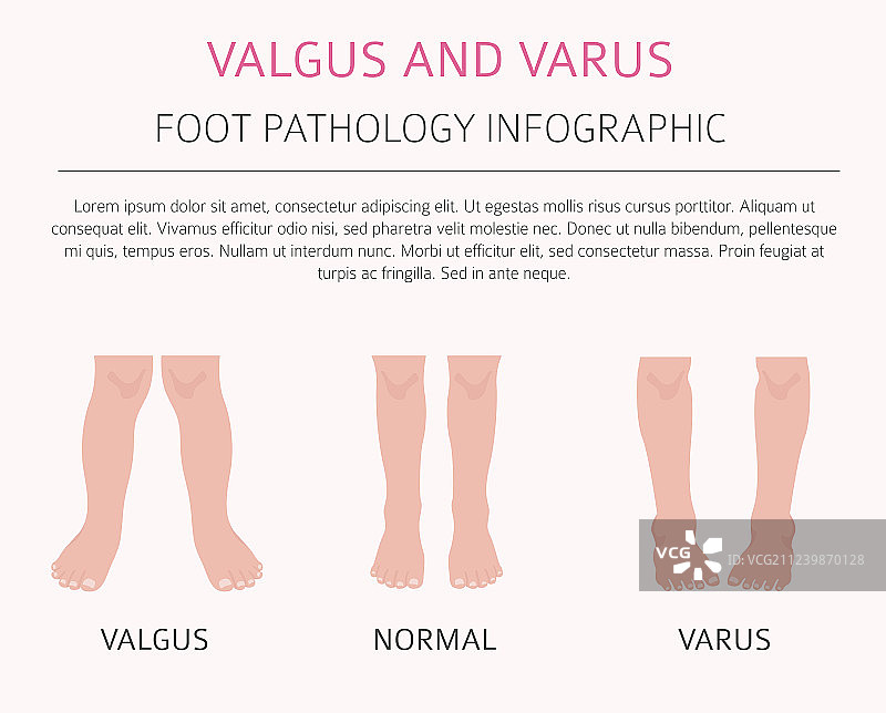 足部畸形医学疾病信息图图片素材