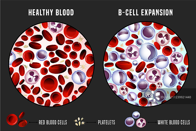 白血病信息图图片素材