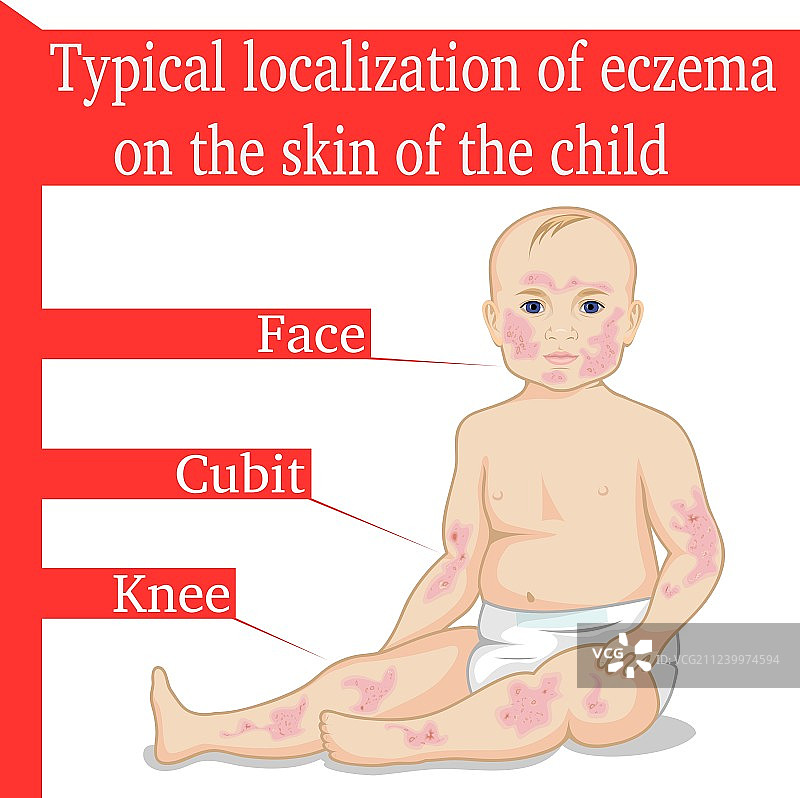 儿童湿疹图片素材